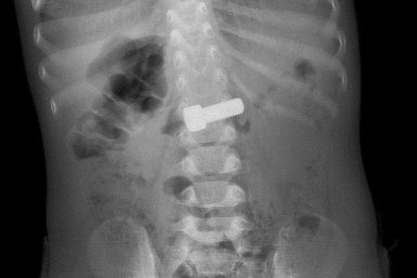 Годовалый малыш проглотил болт в Подмосковье Telegram / &quotРазборчивым почерком&quot